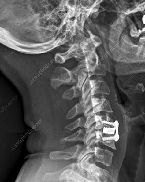 Cervical Intervertebral Disc Implant X Ray Stock Image C0337531