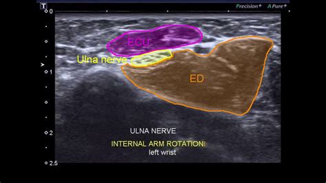 Ultrasound Entrapment Of The Pin Radial Nerve Forearm