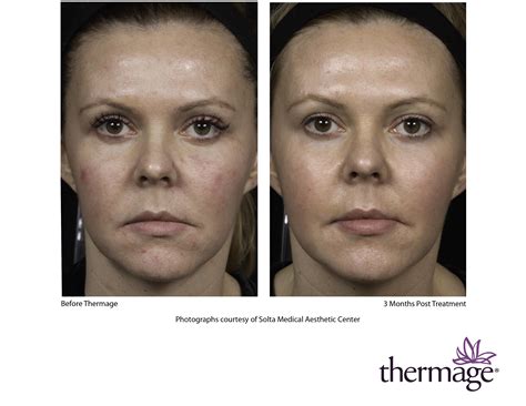 Thermage Eyes Before And After