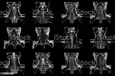 Set Of Coronal Mri Scans Of Neck Area Of Caucasian Male With Bilateral