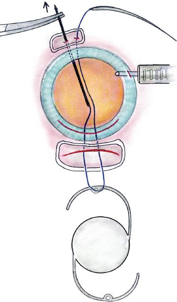 Scleral And Iris Sutured Posterior Chamber Intraocular Lenses And Intraocular Knot Tying