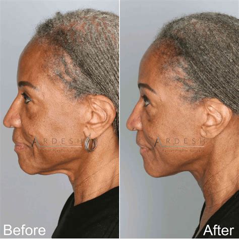 Neck Lift Before And After Ardesh Facial Plastic Surgery