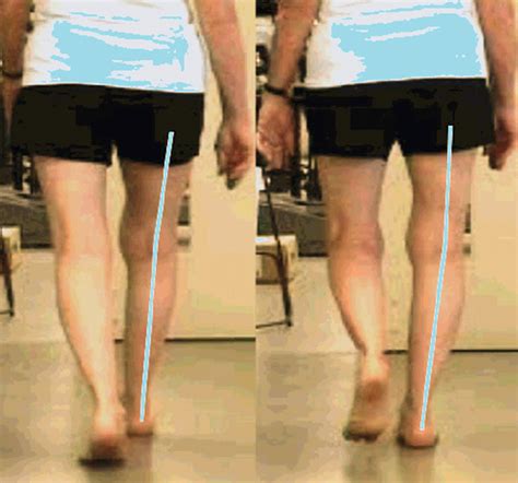 Resolve Your Knee Pain By Addressing Its Alignment Msk Neurology