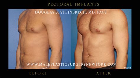Male Pec Implants Male Chest Implants Pectoral Enhancement
