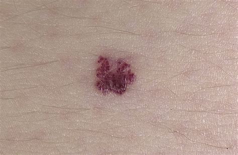 Vascular Hemangioma Pictures 118 Photos And Images