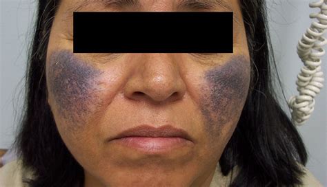 Derm Dx Bluish Black Discoloration Of The Face Clinical Advisor