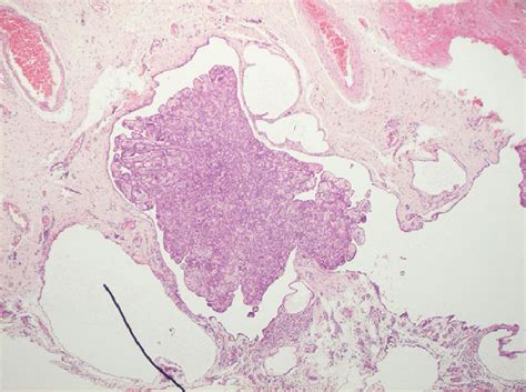 Hande Staining Of The Specimen Demonstrating A Fibrous Cyst Wall Covered