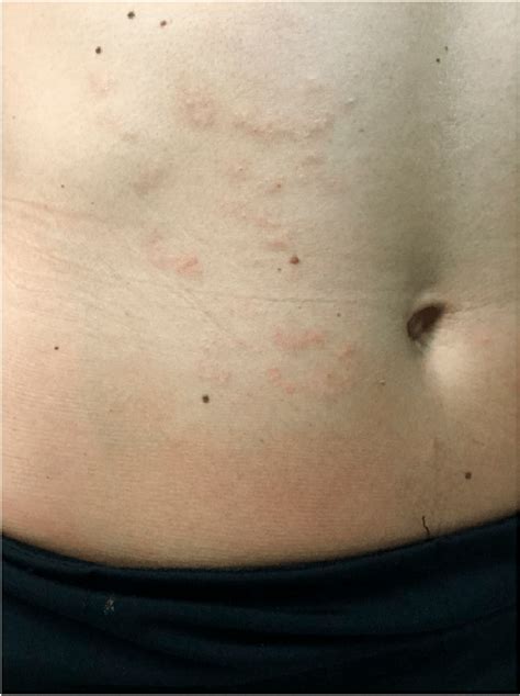 Resolution Of The Right Anterior Abdominal Wall Follicular Rash This
