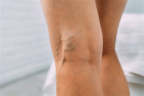 What Causes Veins To Show In Legs The Vein Center Of Maryland