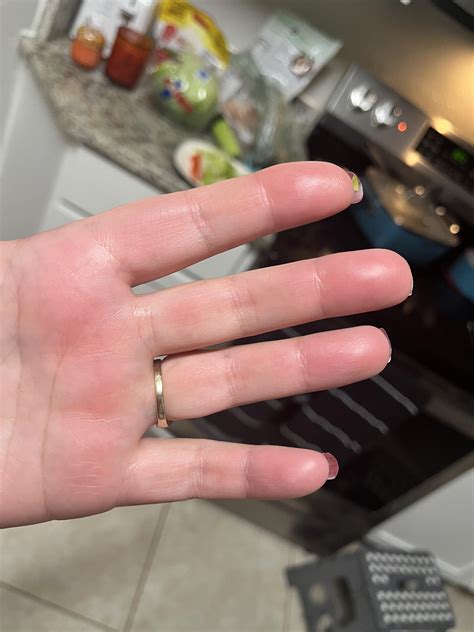 Does This Look Like Raynauds Rraynauds