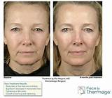 23 Checked And Accredited Radiofrequency For Facial Rejuvenation