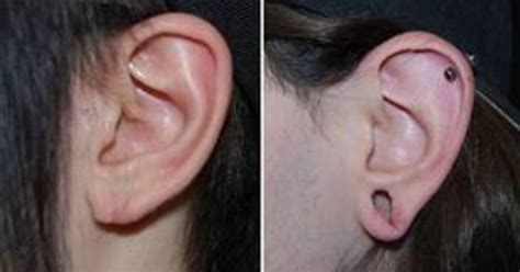 Hey Hipsters New Surgery Can Reverse Stretched Out Ear Lobes
