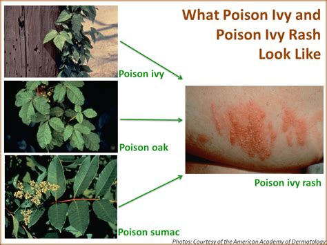 How Long Does Poison Ivy Rash Keeps Spreading