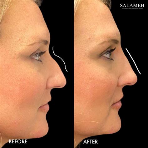 Liquid Rhinoplasty Nose Surgery Salameh Plastic Surgery