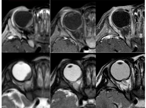 A B C Axial Post Contrast T1 Weighted Image With Fat Suppression D