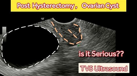 Post Hysterectomy Ovarian Cyst Tvs Ultrasound Youtube