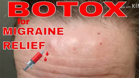 Botox Injections For Migraine Sufferers How You May Feel What You