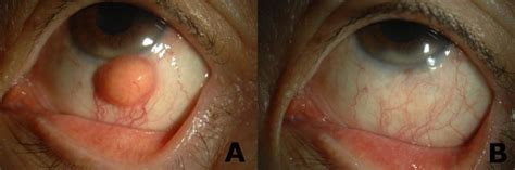 Old Age Onset Subconjunctival Juvenile Xanthogranuloma Without Limbal