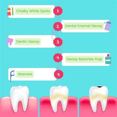 The Stages Of Tooth Decay Spring Dental