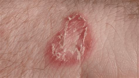 Bullseye Rashes Ringworm And Lyme Disease Differences And My Diagnosis