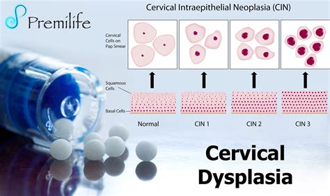 Displasia Cervical Tratamiento Para El Virus Del Papiloma Humano En