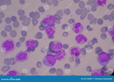 Immature And Mature White Blood Cells Stock Image Image Of Diagnosis