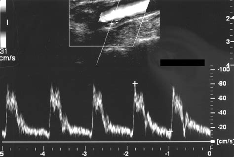 A Spectrum Of Doppler Waveforms In The Carotid And Vertebral Arteries AJR