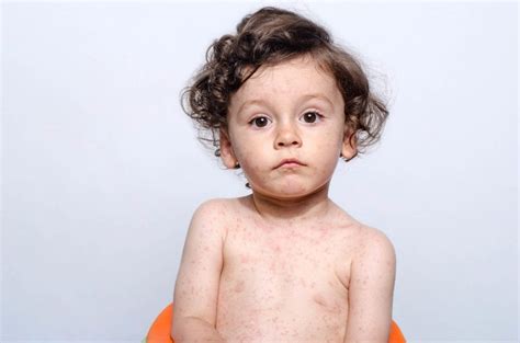 How To Recognise And Treat Mumps Measles Scarlet Fever And Hand Foot