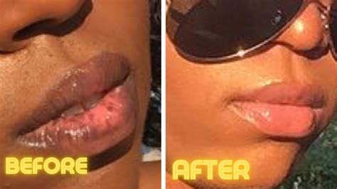 How To Fix Discolored Lips From Smoking
