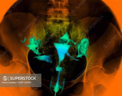 Hysterography X Ray Of Female Reproductive Organs A Contrast Medium Was Introduced Into The