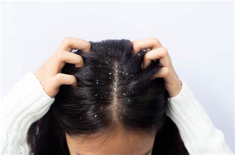 How To Remove Dandruff With These Simple Home Remedies Be Beautiful India
