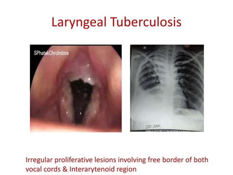 Laryngeal Tuberculosis Ppt