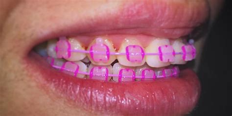 10 Colored Pink Braces For Charming Teenage Girls Braces Explained