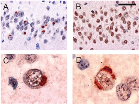 Ubiquitin Immunoreactive Neuronal Cytoplasmic Inclusions Nci In