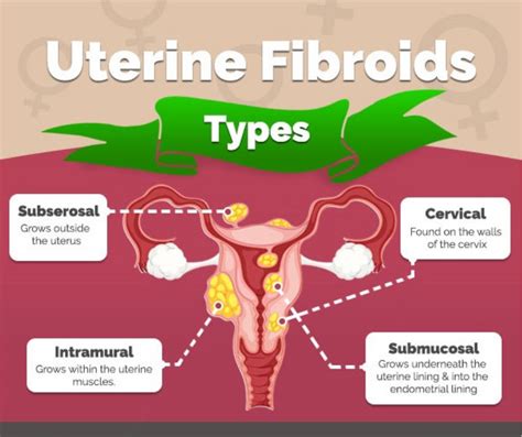 Fibroids Treatments Singapore Drpamela Tan Gynaecologist Singapore