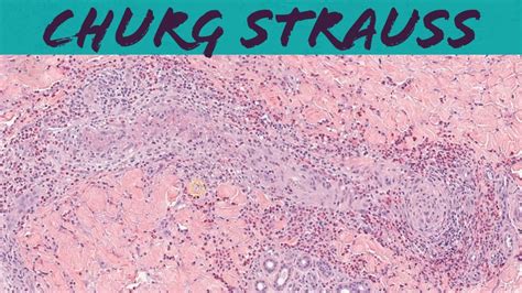 Churg Strauss Syndrome Eosinophilic Granulomatosis With Polyangiitis