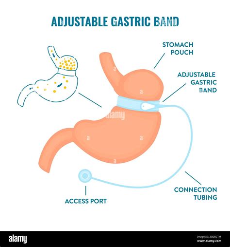 Adjustable Gastric Band Bariatric Surgery Illustration Stock Photo Alamy