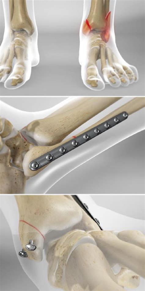 Ankle Fracture Surgery