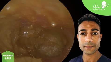 1363 Complex Treatment Of Eczematous Otitis Externa Youtube