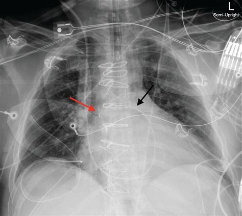 Aortic Balloon Pump Placement