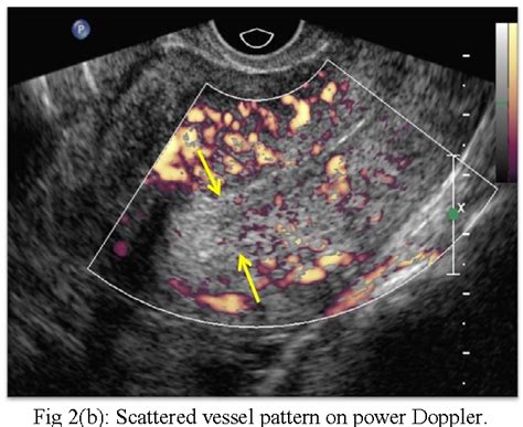 Figure 1 From Role Of Transvaginal Sonography Power Doppler And
