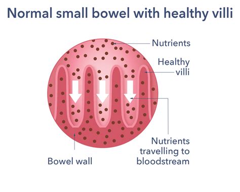 Coeliac Disease Causes Symptoms Treatment And Support Guts Uk