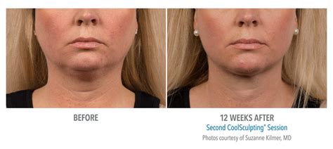 Coolsculpting Beverly Hills Chin Fat Reduction Body Contouring