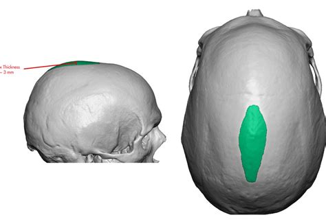 Blog Archivecase Study Sagittal Crest Head Reshaping