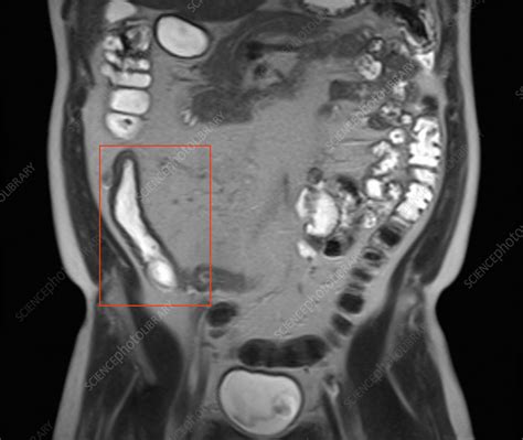 Small Intestine In Crohn S Disease MRI Stock Image C Science Photo Library