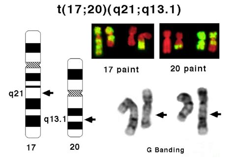 Translocation Between Chromosomes 17 And 20 Photograph By Dept Of Clinical Cytogenetics