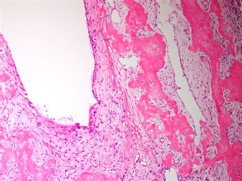Aneurysmal Bone Cyst Histology