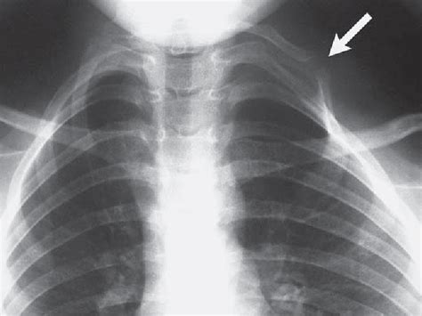 Figure 1 From Cervical Rib Fracture An Unusual Etiology Of Thoracic