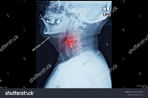 Lateral Projection Cervical Spine Xray Showing Stock Illustration