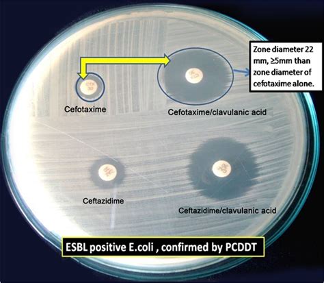 Antibiogram Of Extended Spectrum β Lactamase Esbl Producing